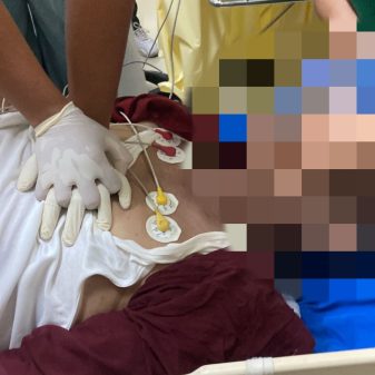 Mantan Bupati Kuningan Acep Purnama, Keritis Diduga Kena Serangan Jantung