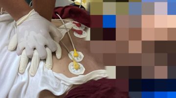 Mantan Bupati Kuningan Acep Purnama, Keritis Diduga Kena Serangan Jantung